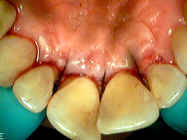 https://www.dottorgiuseppebellinvia.info/wp-content/uploads/2021/05/dentista-firenze-giuseppe-bellinvia-paradontologia-2.jpg