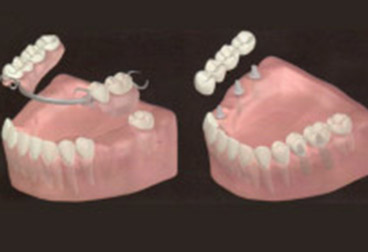 https://www.dottorgiuseppebellinvia.info/wp-content/uploads/2021/06/protesi-mobile-impianto-dentale.jpg